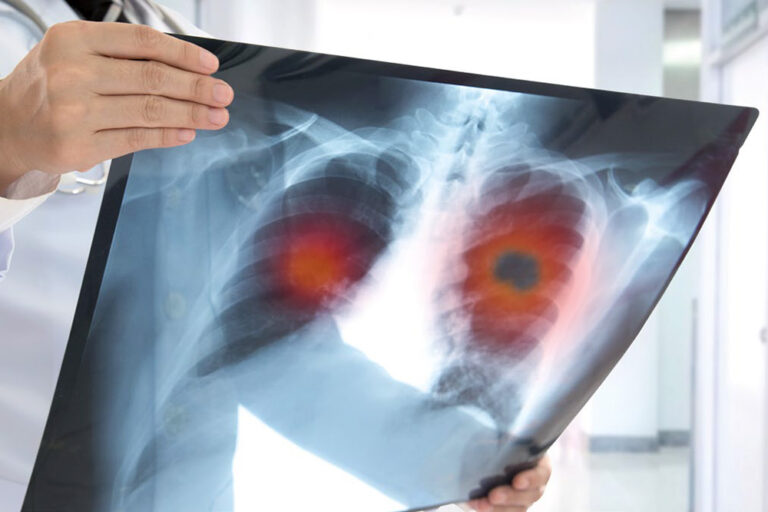 Lungenzentrum Lippe: Diagnostik und Therapie aus einer Hand